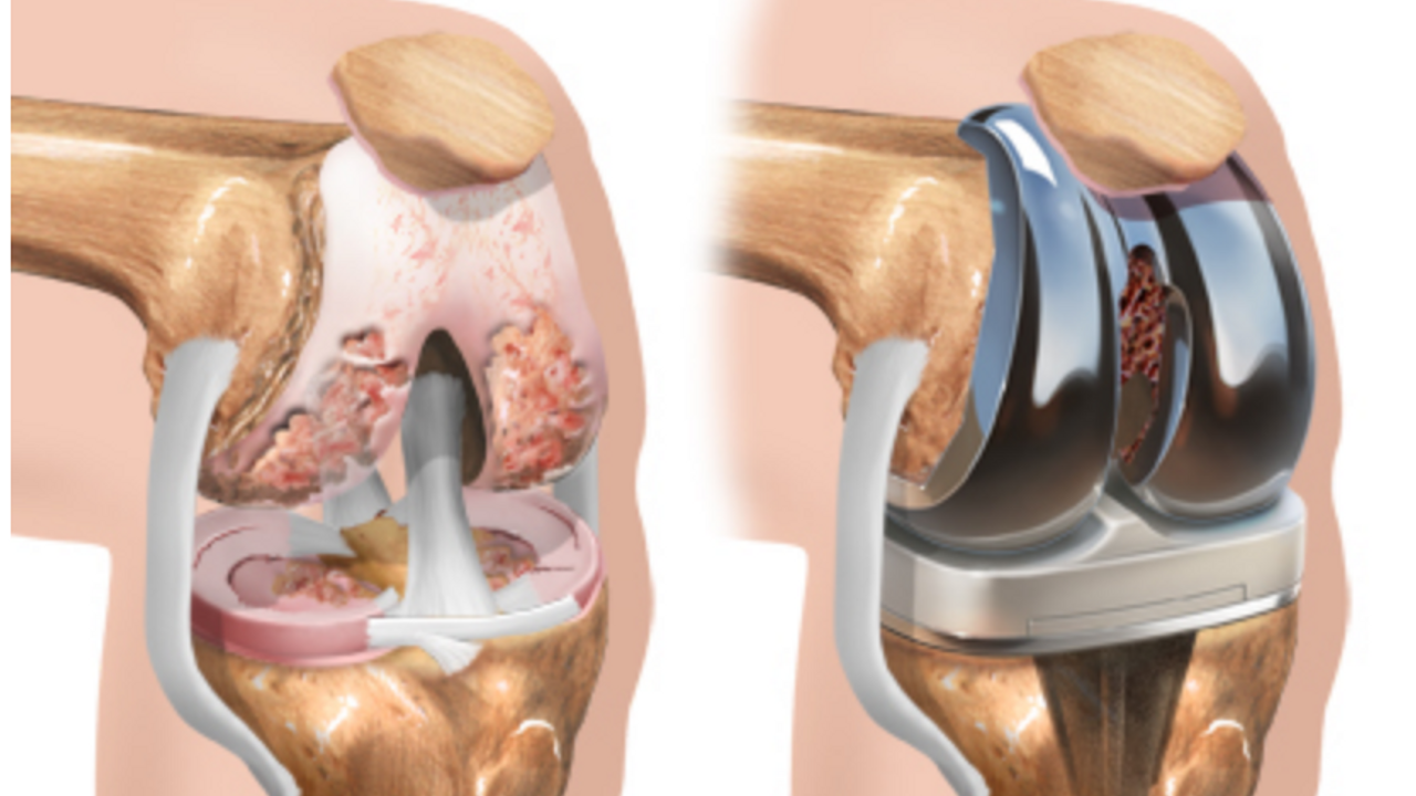 Knee Replacement Surgery Jaipur